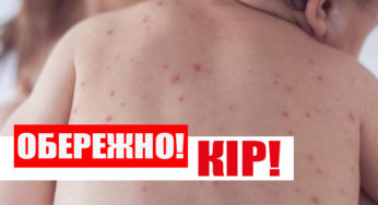 За півроку у Хмельницькому захворіло на кір майже 1 тис. людей